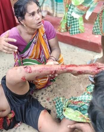 ବୋମା ବିସ୍ଫୋରଣରେ ନାବାଳକ ଗୁରୁତର