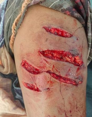 ହନୁମାଙ୍କଡ଼ କାମୁଡିବାରୁ ବୟସ୍କ ମହିଳା ଗୁରୁତର