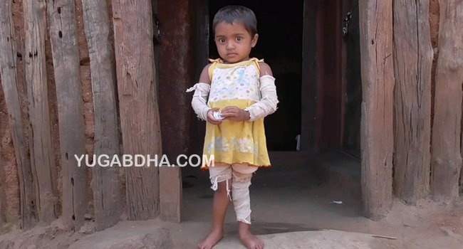 ୨ବର୍ଷର ଝିଅ ଦେହରେ ୨୮ ଥର ବ୍ୟାଣ୍ଡେଜ ;ଚିକିତ୍ସାପାଇଁ ପ୍ରଶାସନର ପ୍ରସ୍ତୁତି