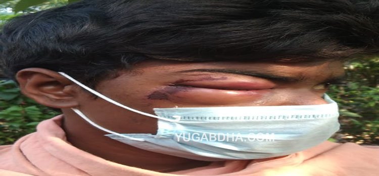 କନେଷ୍ଟବଳ ଲାଠିରେ ଦାଦନ ଶ୍ରମିକର ଚକ୍ଷୁ ନଷ୍ଟ