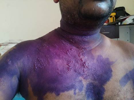 ଇଞ୍ଜେକ୍ସନ ରିଏକ୍ସନ ରେ କନିଷ୍ଠ ଯନ୍ତ୍ରୀ ଗୁରୁତର : ଚିକିତ୍ସା ଅବହେଳାର ତଦନ୍ତ ଦାବି