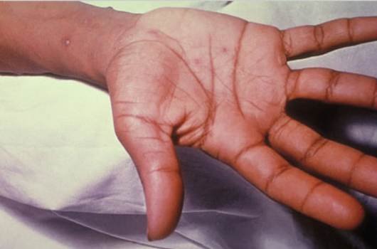 ସିକାଡ଼ି ଗ୍ରାମରେ ମିଳିମିଳା ହାଡ଼ଫୁଟି ରେ ସମସ୍ତେ ପୀଡ଼ିତ